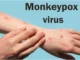 Be careful to avoid monkey pox: एक फिर मंडराया मंकीपॉक्स का खतरा, बचाव के लिए स्वास्थ्य विभाग की एडवायजरी जारी