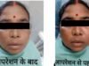 CIMS Bilaspur : दांत की सड़न से जबड़े में बन गई थी बड़ी सिस्ट, सिम्स में हुआ रेडिकुलर सिस्ट का सफल उपचार