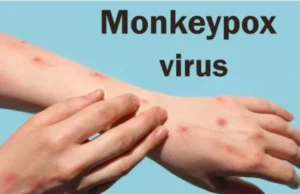Be careful to avoid monkey pox: एक फिर मंडराया मंकीपॉक्स का खतरा, बचाव के लिए स्वास्थ्य विभाग की एडवायजरी जारी