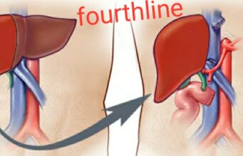 Health care: कैंसर या अन्य गंभीर मर्ज का अब छत्तीसगढ़ में ही आसान और सफल इलाज संभव