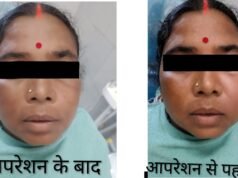 CIMS Bilaspur : दांतों की सड़न को हल्के में न लें, जबड़े में बन गई थी बड़ी सिस्ट, सिम्स में हुआ रेडिकुलर सिस्ट का सफल उपचार