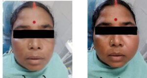 CIMS Bilaspur : दांत की सड़न से जबड़े में बन गई थी बड़ी सिस्ट, सिम्स में हुआ रेडिकुलर सिस्ट का सफल उपचार