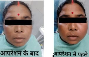 CIMS Bilaspur : दांत की सड़न से जबड़े में बन गई थी बड़ी सिस्ट, सिम्स में हुआ रेडिकुलर सिस्ट का सफल उपचार
