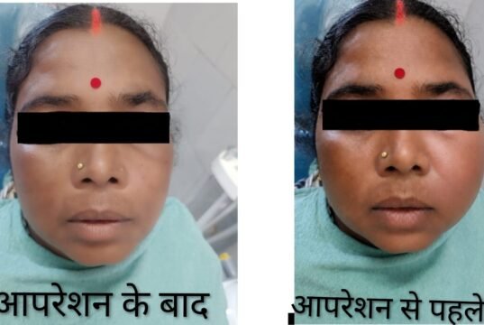 CIMS Bilaspur : दांत की सड़न से जबड़े में बन गई थी बड़ी सिस्ट, सिम्स में हुआ रेडिकुलर सिस्ट का सफल उपचार